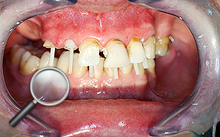 6c. Wzmocnienie kanałów korzeniowych po leczeniu endodontycznym wkładami z włókien szklanych