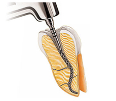 Przekrój zęba z leczeniem kanałowym